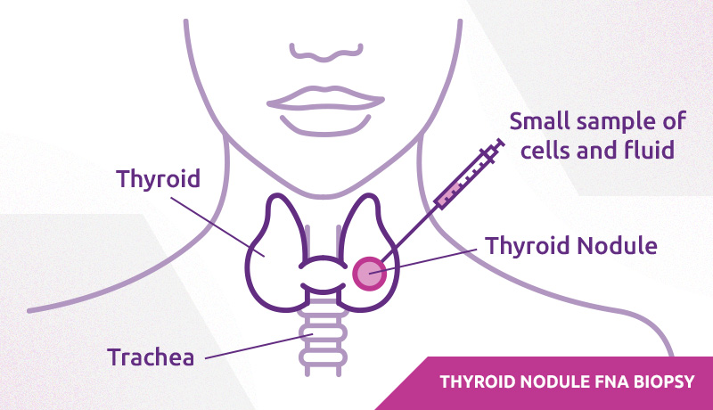 Fine Needle Aspiration (FNA) biopsy