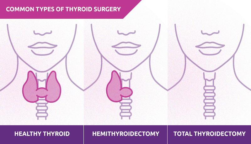 Total Thyroidectomy and Hemithyroidectomy