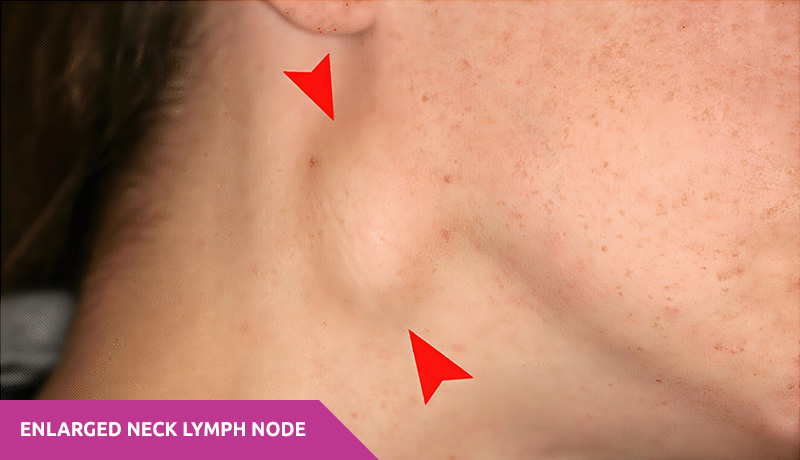 rapid access neck lump clinic - enlarged lymph node