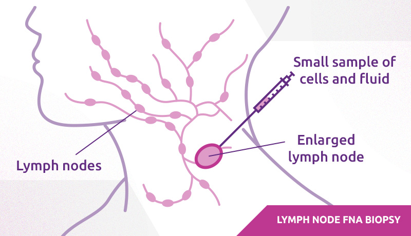 Rapid Access Neck Lump Clinic - lymph node FNA biopsy